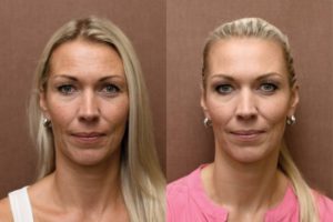Фото до и после плазмолифтинга лица